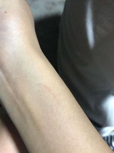 要吃老鼠,也在外面跑,今天晚上不小心被它的爪子划伤了