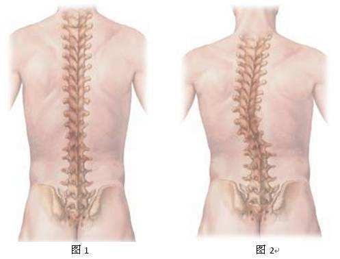 你还在跷二郎腿吗看看它对脊柱的危害有多大