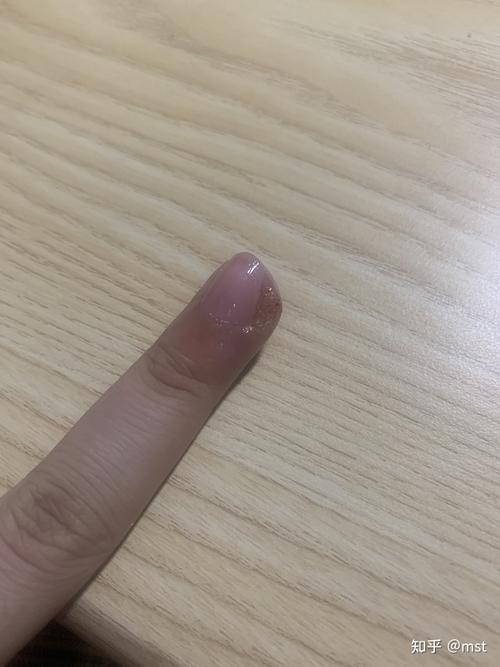 甲下疣 跎疣 你们怎么治好的