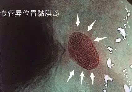 barrett食管背后的故事(2):真假巴雷特