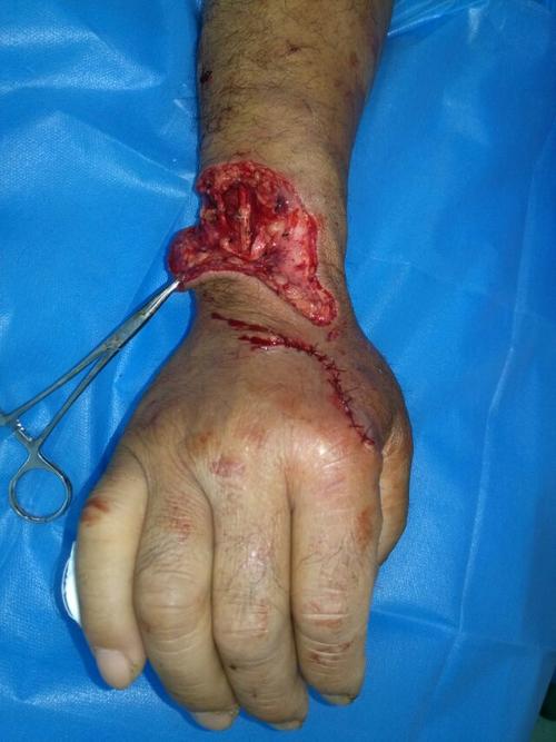 手足外伤皮肤缺损皮瓣修复方法的选择