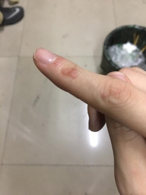 请问手指上长得这种肉块是什么啊