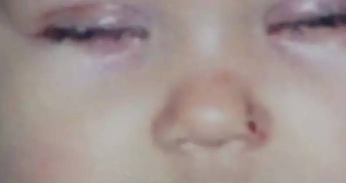 戳瞎眼睛竟毫无知觉,不是没有疼痛的天堂,而是基因缺陷的地狱