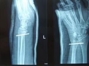 下尺桡关节脱位的诊断和治疗