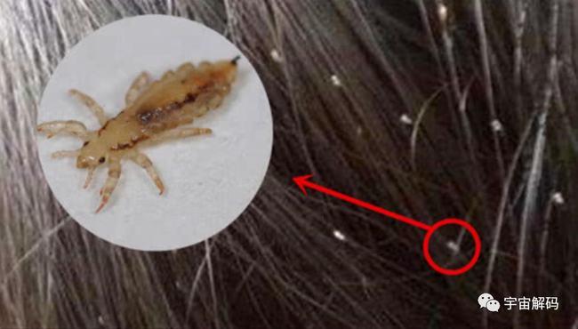 并且被虱子咬了,不仅是发痒那么简单,对人身体造成的伤害也不小,回归