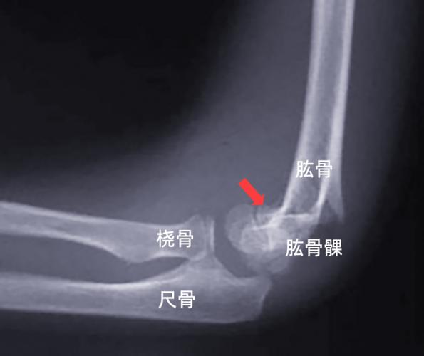 肱骨近折端向后下移位,远折端向前移位,为屈曲型肱骨髁上骨折的表现.