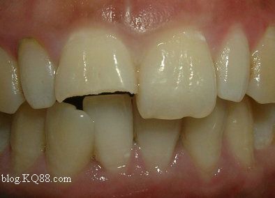 冠折树脂分层修复