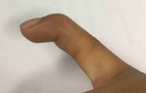 手指肌腱断裂,最后一节无法伸直.医生教我不要治疗了.