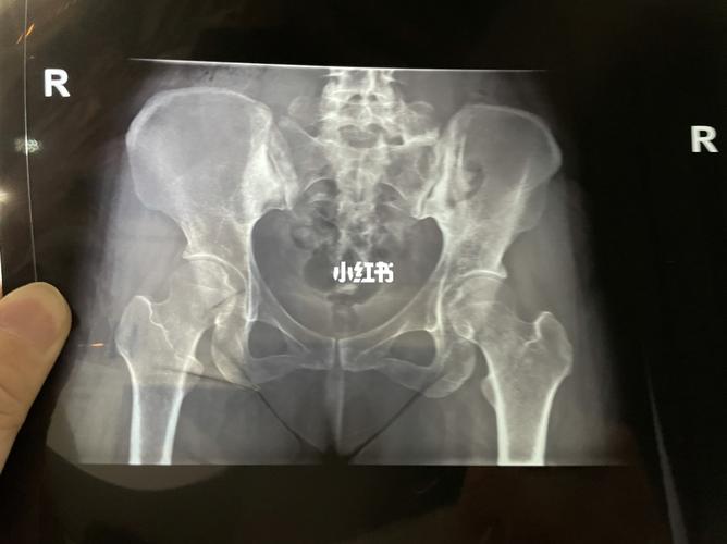 先天性髋关节发育不良_医疗健康_医疗健康其他