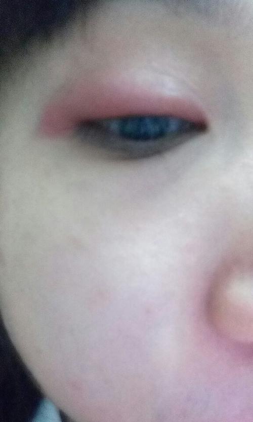 近期时常无故过敏眼睛肿,最明显的是化了眼线后就会肿