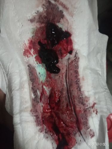 今天药流第十五天