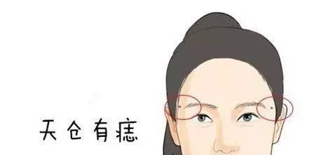 天仓有痣天仓的范围内有痣,包括左右两个天仓,这两个地方,对应的是辰