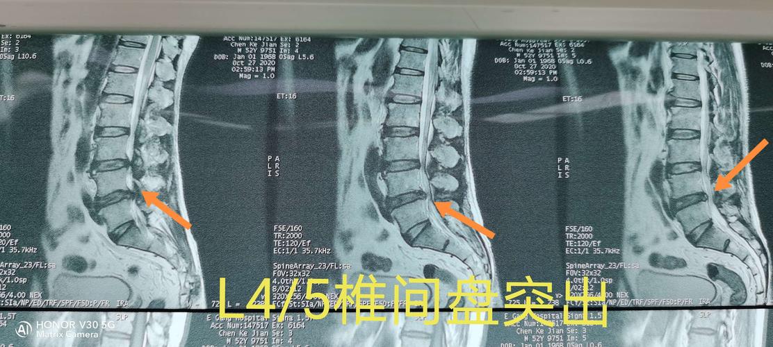 术前mri示l4/5椎间盘向左侧突出