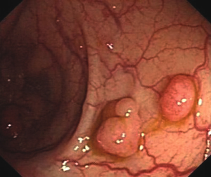 图4 胃镜:胃体多发息肉.                    图5 结肠镜:多发息肉.