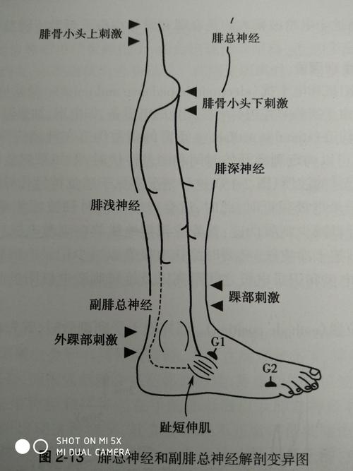 2.腓总神经变异:是下肢最常见的生理变异,即出现一个副腓总神经.