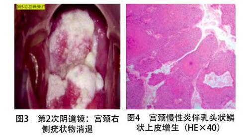 宫颈受累的白塞氏病二例