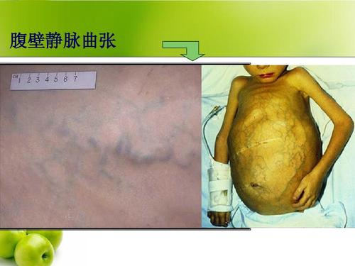 腹壁静脉曲张