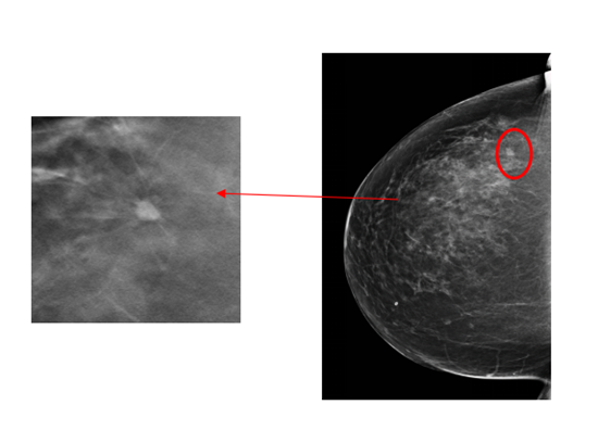 哈医大一院数字化乳腺断层摄影实现乳腺癌早期发现