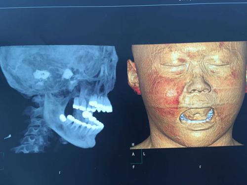 智齿发炎不拔 引起间隙感染 ,两周后再到颌面部多间隙感染 ,整个下颌