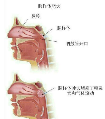 小儿腺样体肥大何时需要手术?