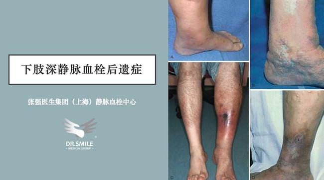 世界血栓日被忽略的下肢深静脉血栓后遗症