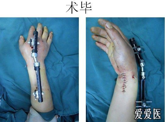 外固定支架结合克氏针有限内固定治疗桡骨远端粉碎性骨折