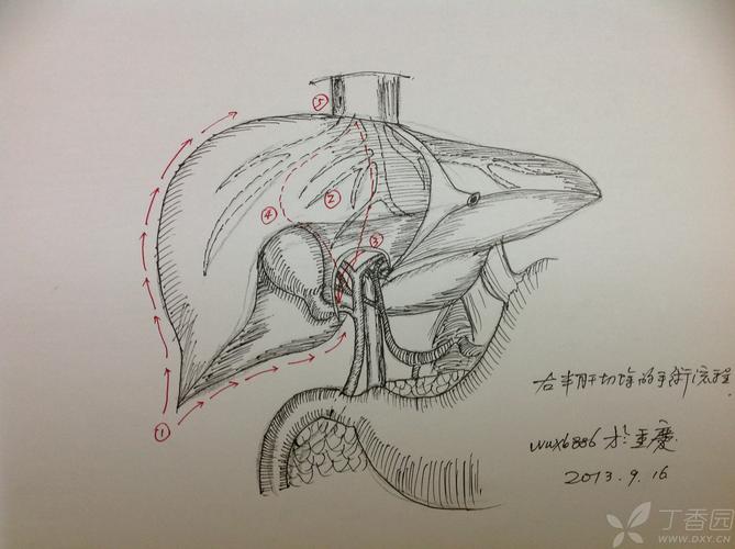 【交流】肝胆手绘解剖(开始肝脏ct解剖系列,持续更新中)1