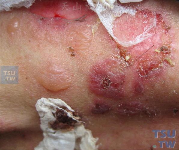 天疱疮:寻常型天疱疮的症状表现