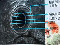 图为腔内探头——正常直肠肠壁声像图