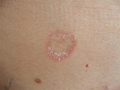 花斑癣会不会传染,预防治愈双管齐下