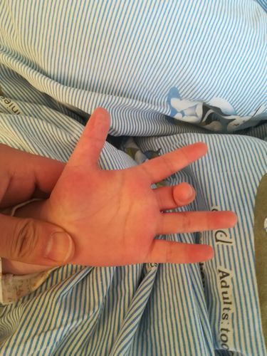 狭窄性腱鞘炎手术治疗中指