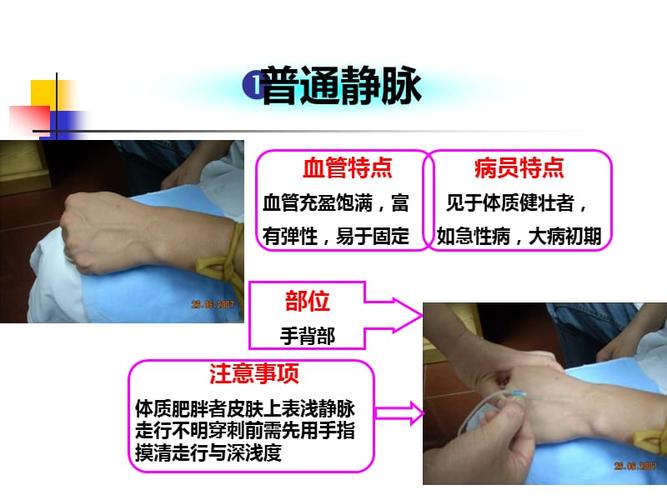 静脉输液穿刺技巧(1).ppt