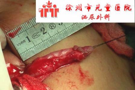 图说小儿泌尿外科之:男性假两性一期手术