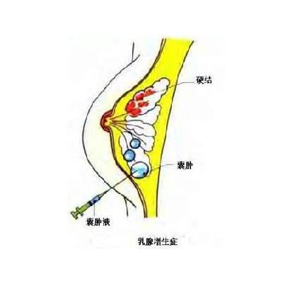乳腺结节
