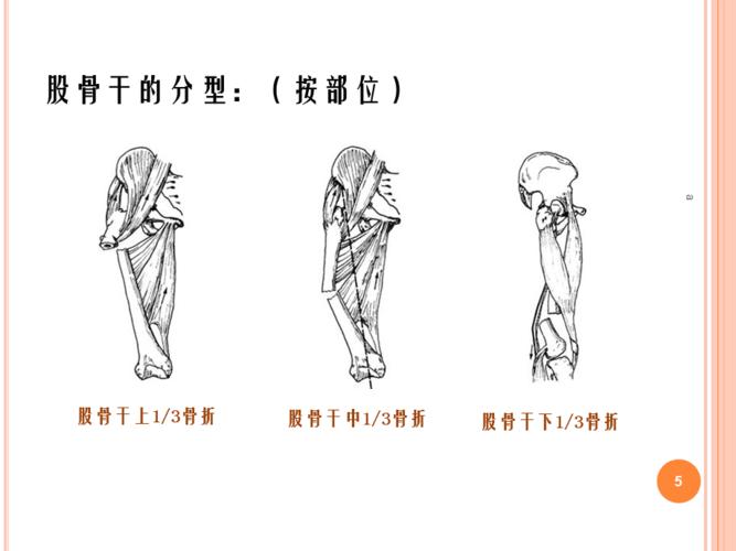 股骨干骨折护理与治疗ppt课件pptx
