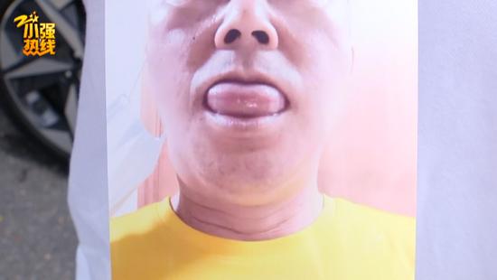新车开了一个月浙江男子感觉要窒息舌头比原来大了4倍