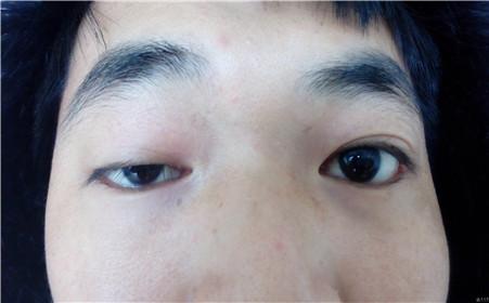 要区别上睑下垂与重症肌无力