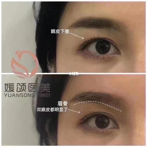 眉骨|宝藏抗衰部位_宝尼达眉骨_美妆_医美整形