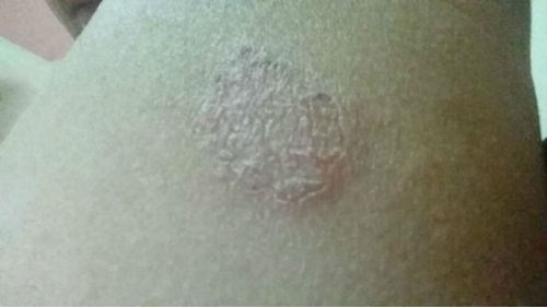 男性手臂体股癣的图片