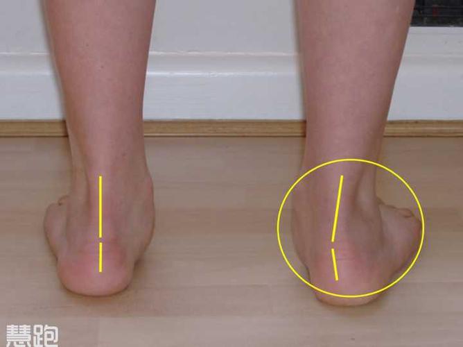 扁平足本身是一种正常现象,许多马拉松运动员也是扁平足,但如果扁平足