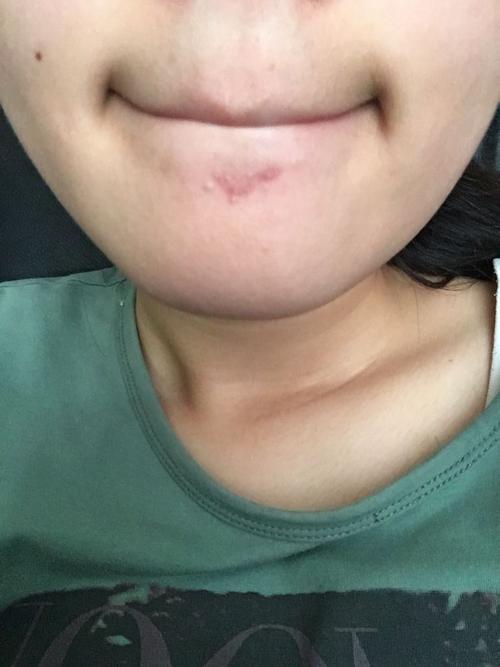 下巴长小包一直不消