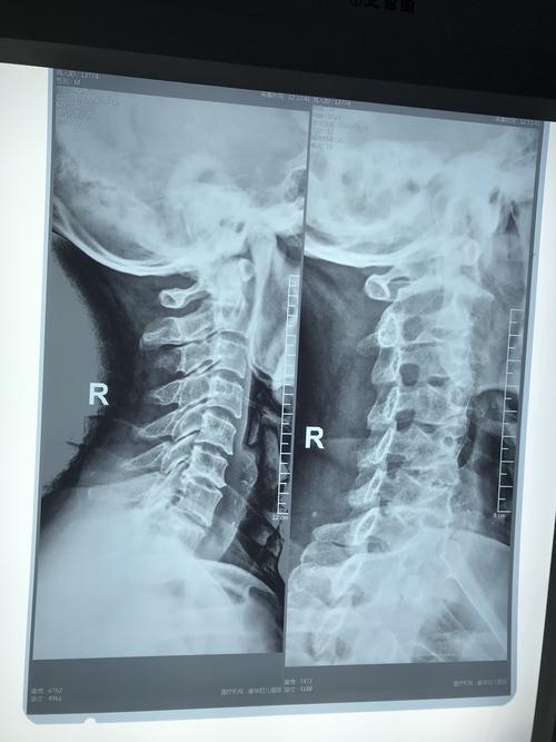 针对颈椎病的微创钩解活玄疗法