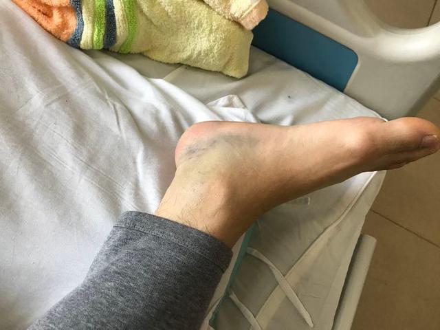 脚踝处淤青肿胀