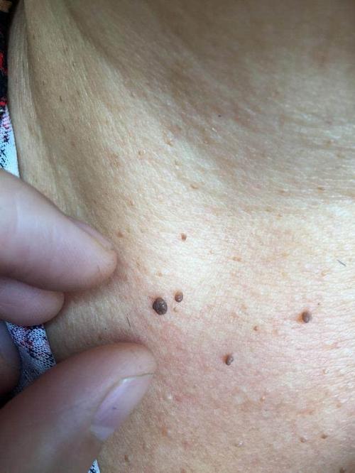 疣,是hpv病毒的感染,是具有传染性的,而发生在孕妇脖子上的这些并没有