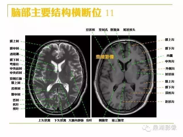 颅脑大体及磁共振断层解剖(轴位)
