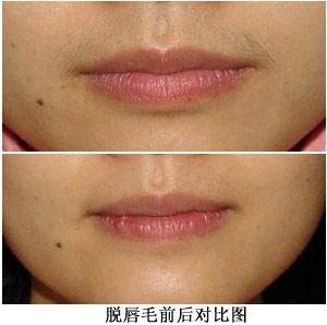 广州唇毛怎么脱 美莱元旦美容优惠