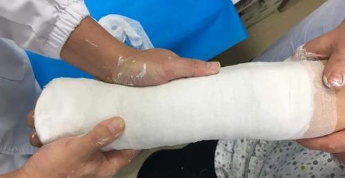 "石膏",是 无水硫酸钙(caso4)的细粉末散在特制的细孔纱布绷带上制成