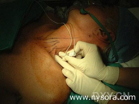 操作前准备:1,病人准备:术前禁食水6-8小时,常规备皮.