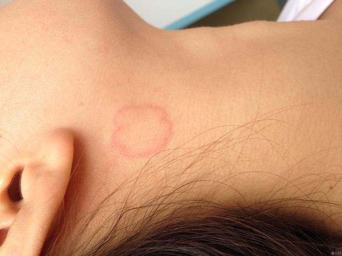 08:42:57之前头皮痒,后吃西比利秦 后颈脖,头皮多发性圆圈型红斑,没