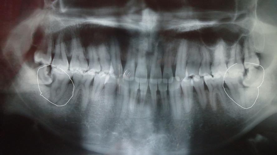 请问这是根尖炎吗?